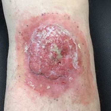 symptoms of skin cancer on leg