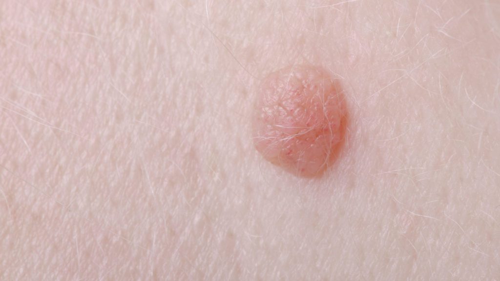 Warts vs. Skin Cancer | Can a Wart Be Skin Cancer?