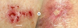 Can Eczema be Confused with Skin Cancer? | Eczema or Skin Cancer ...