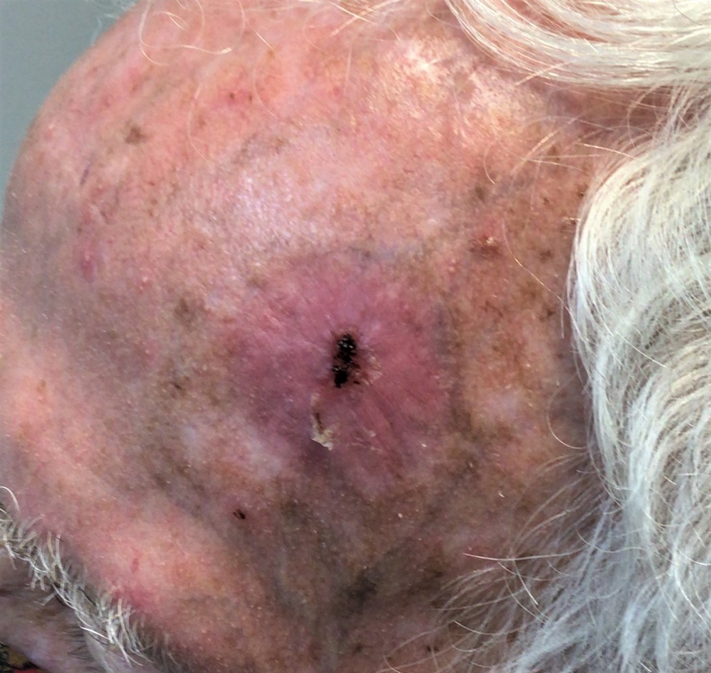 What Does Skin Cancer Look Like On The Face GentleCure